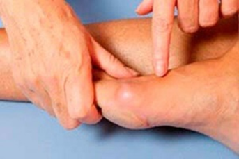 Schwellung und Entzündung der Beine vor der Anwendung von Hondrogel