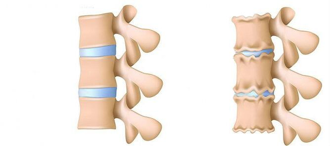 Osteochondrose von innen
