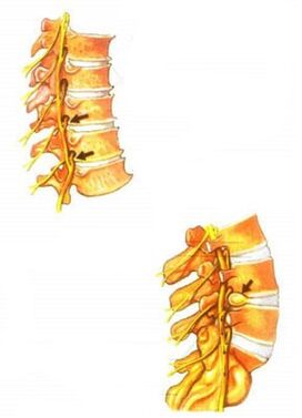 Darstellung der Osteochondrose der Wirbelsäule