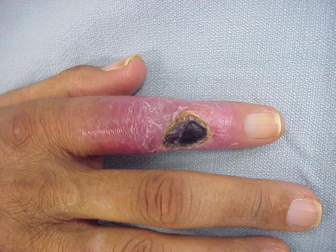 Osteomyelitis als Ursache von Schmerzen in den Fingergelenken