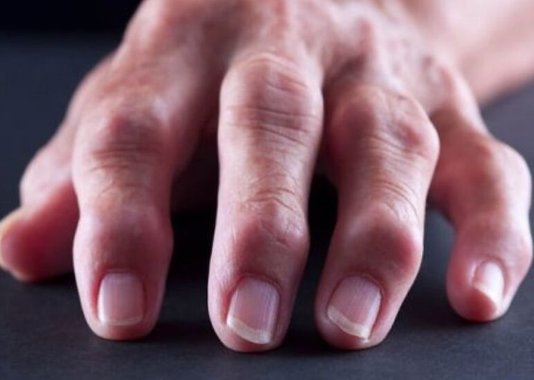 rheumatoide Arthritis als Ursache von Schmerzen in den Fingergelenken