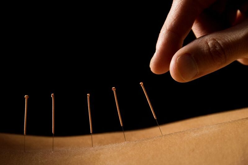 Akupunktur bei Rückenschmerzen