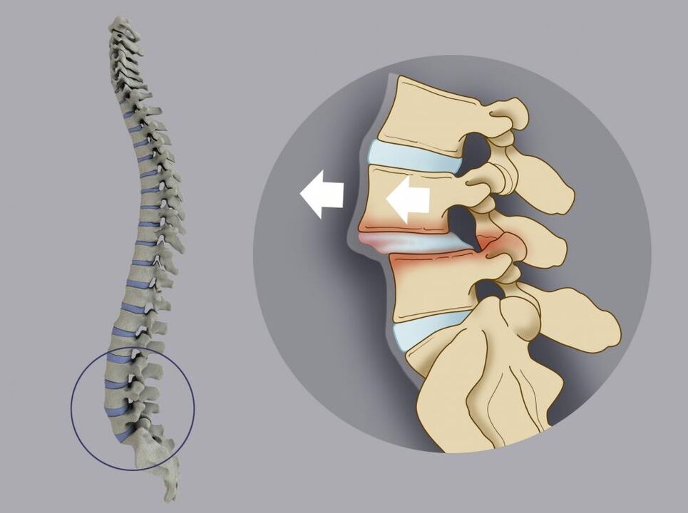 Verlagerung der Wirbel als Ursache von Rückenschmerzen